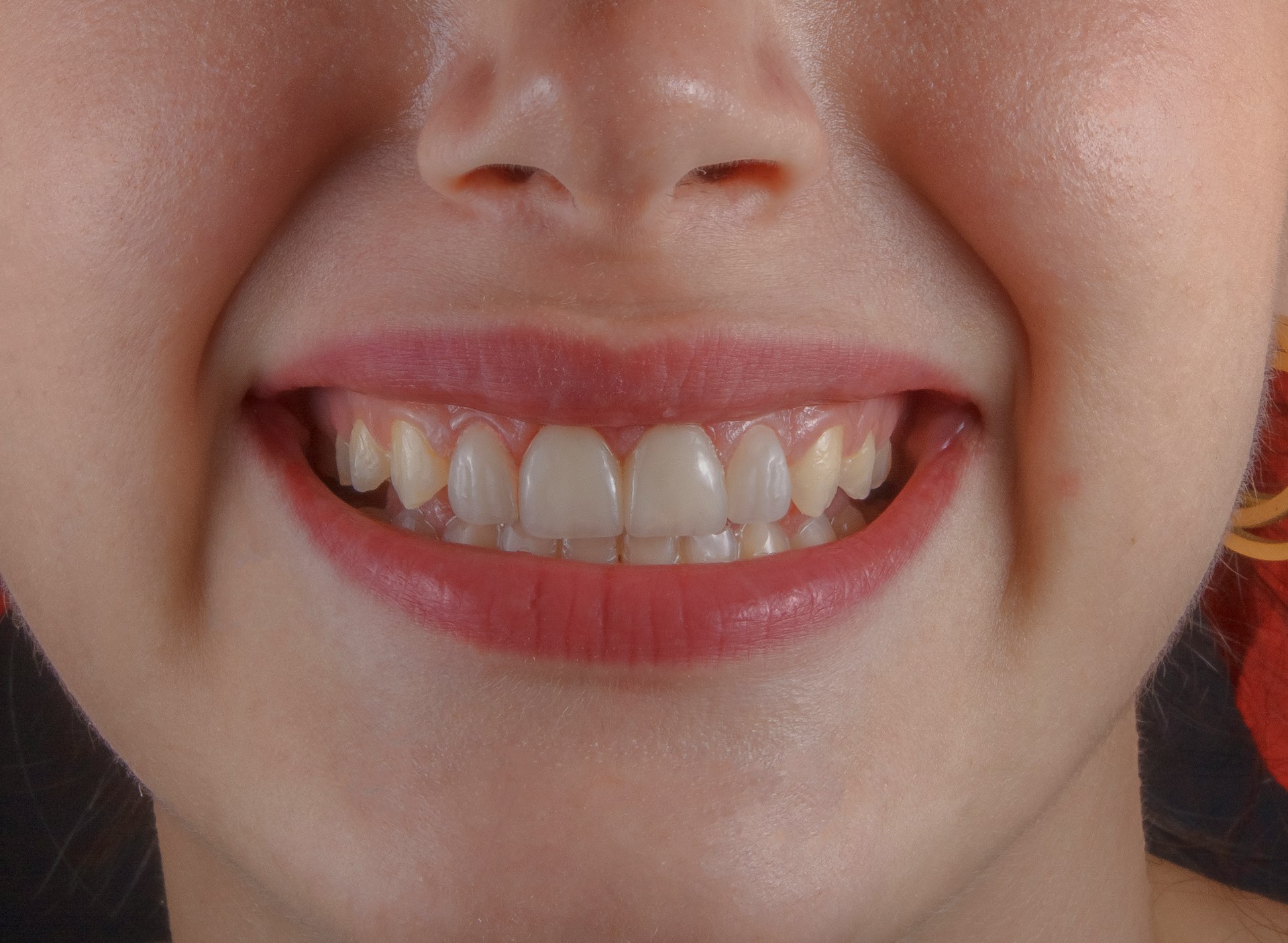 Would You Rather Lose All Your Teeth Or All Your Toes?